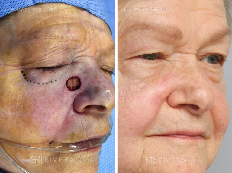 Cheek wound reconstruction from skin cancer removal with V-Y advancement flap - Woman - Case 111216 - Before and after - Oblique view