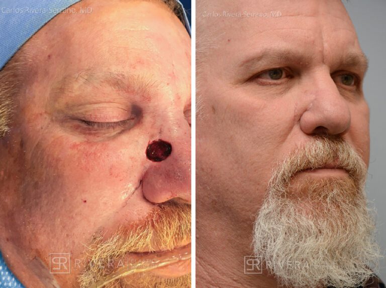 Cheek & Nose wound reconstruction from skin cancer removal with V-Y advancement flap - Man - Case 111218 - Before and after - Oblique view