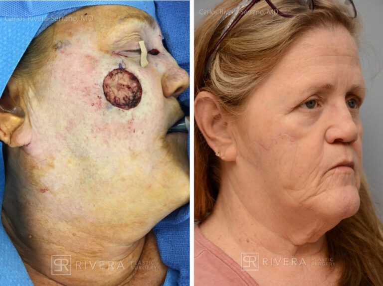 Check wound reconstrucion from skin cancer removal with large bilobed rotational flap - Woman - Case 111219 - Before and after - Oblique view