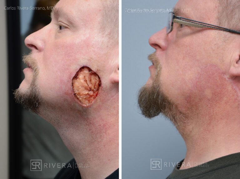 Cheek & chin reconstruction in male patient - Face & neck reconstruction - Facelift - Skin cancer - Before and after case 2 - Profile View