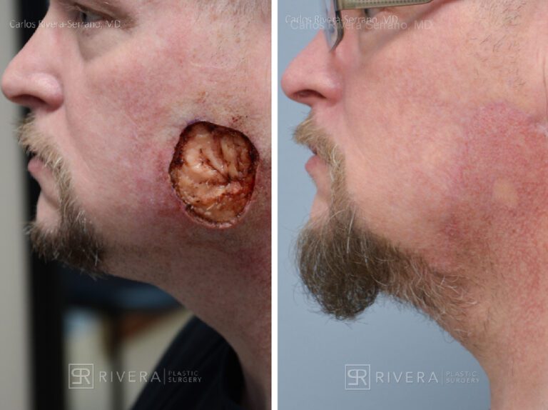Cheek wound reconstruction from skin cancer removal with large Cervicofacial flap - Man - Case 11122 - Before and after - Profile view