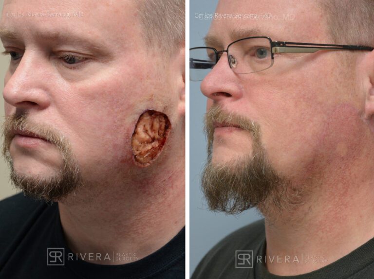 Cheek wound reconstruction from skin cancer removal with large Cervicofacial flap - Man - Case 11122 - Before and after - Oblique view