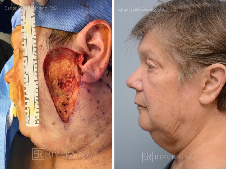 Cheek wound reconstruction from skin cancer removal with large Cervicofacial flap - Woman - Case 11123 - Before and after - Lateral view