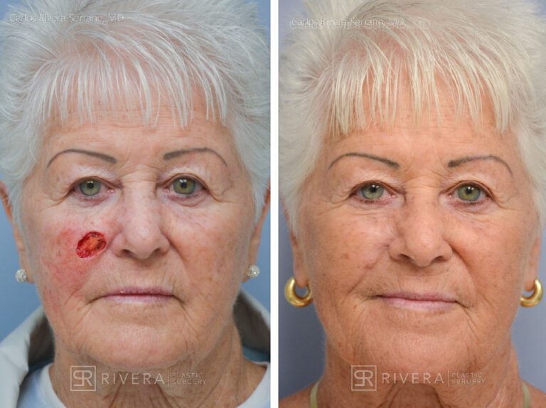 Cheek wound reconstruction from skin cancer removal with Burow's Triangle Displacement flaps - Woman - Case 11124 - Before and after - Frontal view
