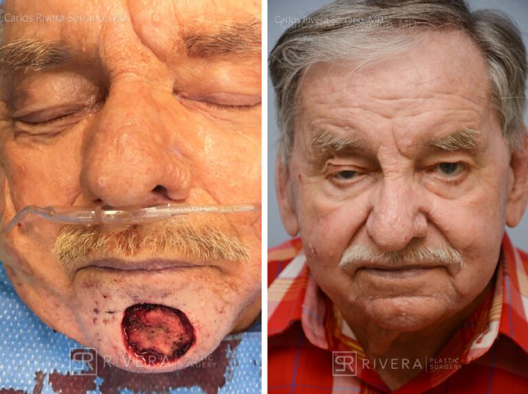Chin wound reconstruction from skin cancer removal with bilateral Advancement flaps (A-T flaps) - Man - Case 11125 - Before and after - Frontal view
