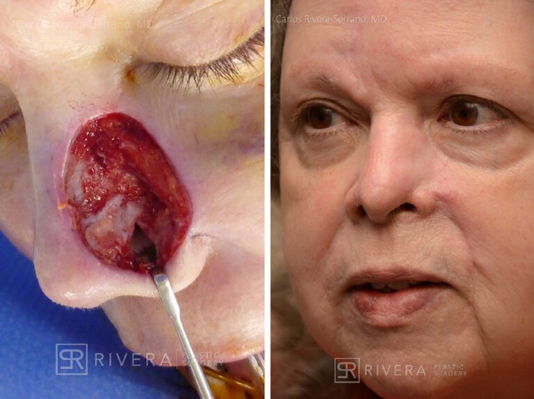 Cheek & Nose wound reconstruction from skin cancer removal with Paramedian forehead flap & cheek advacement flap - Woman - Case 11126 - Before and after - Oblique view