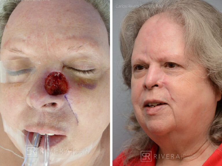 Cheek & Nose wound reconstruction from skin cancer removal with Paramedian forehead flap & cheek advacement flap - Woman - Case 11126 - Before and after - Oblique view
