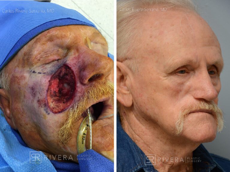 Cheek wound reconstruction from skin cancer removal with Paramedian forehead flap & cheek advacement flap - Man - Case 11127 - Before and after - Oblique view