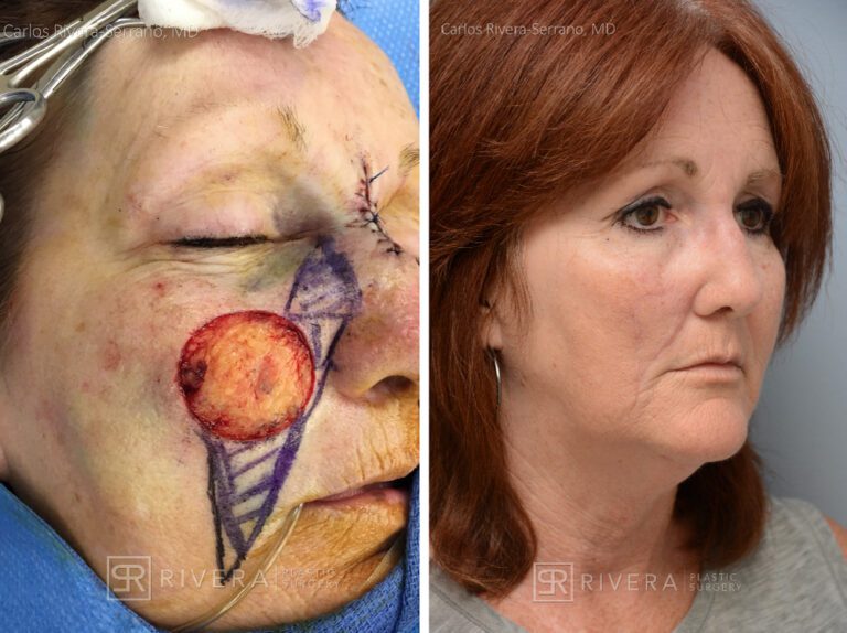 Cheek wound reconstruction from skin cancer removal with V-Y flap & advancement flap - Woman - Case 11128 - Before and after - Oblique view