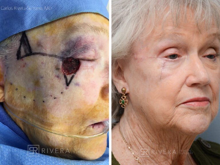 Cheek - lower eyelid wound reconstruction from skin cancer removal with Burow's Triangle Displacement Flap - Woman - Case 11129 - Before and after - Oblique view