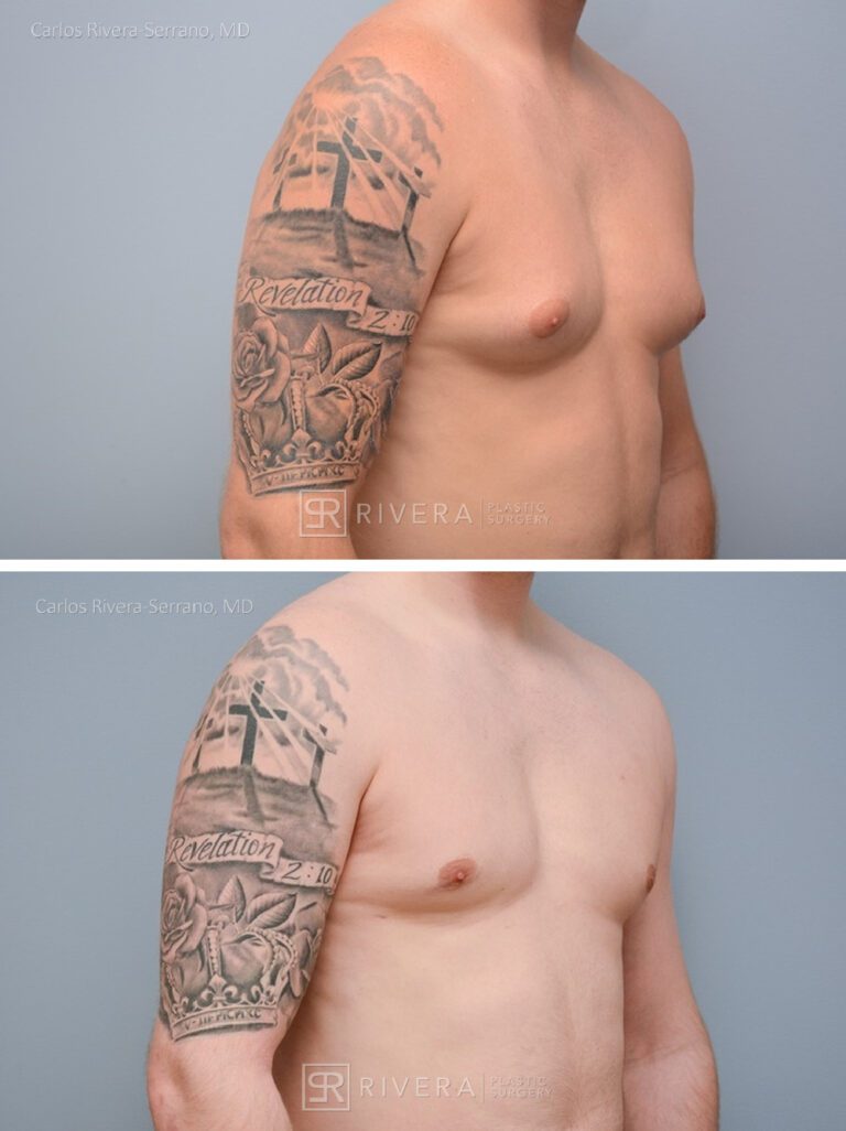 Chest Reduction Surgery for Men (Gynecomastia) - Man - Case 21101 - Before and after - Oblique view