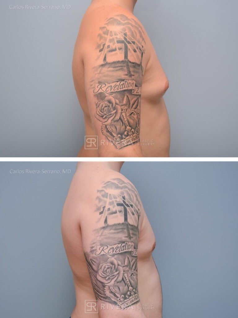 Chest Reduction Surgery for Men (Gynecomastia) - Man - Case 21101 - Before and after - Lateral view