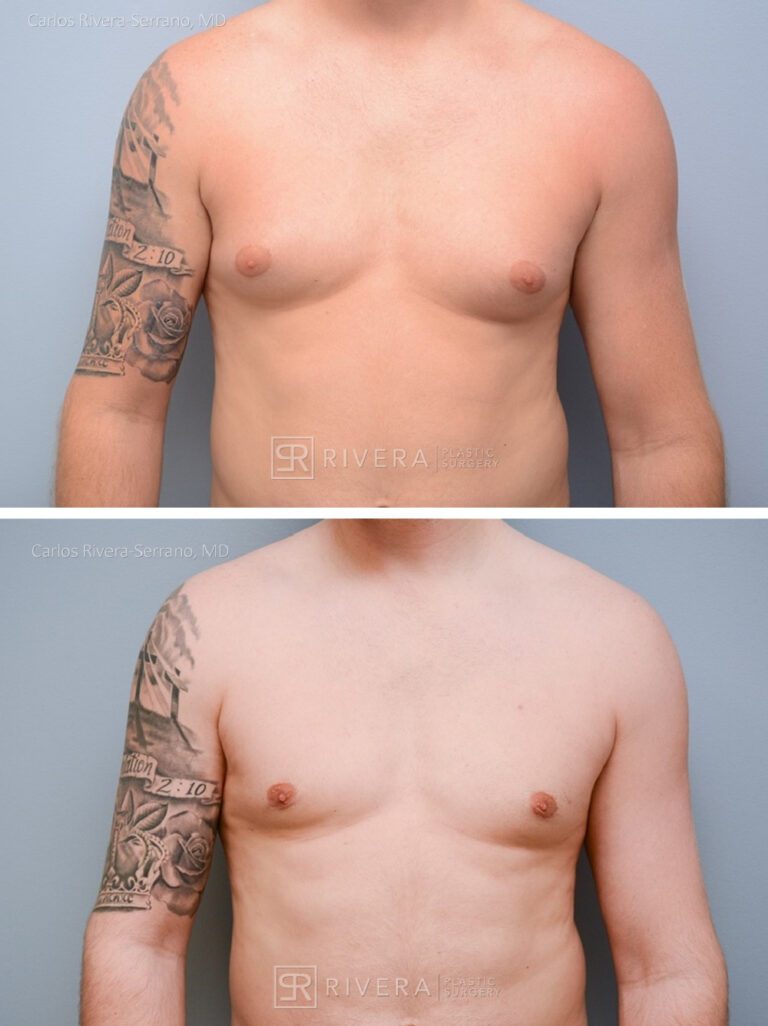 Chest Reduction Surgery for Men (Gynecomastia) - Man - Case 21101 - Before and after - Frontal view