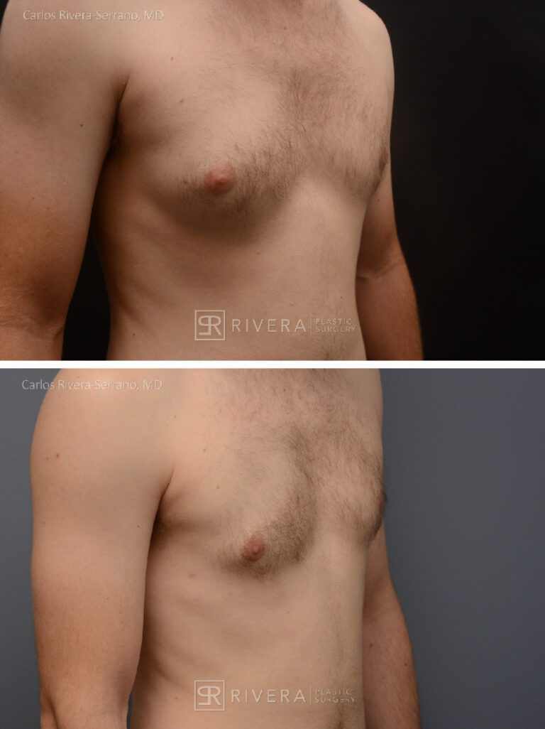 Chest Reduction Surgery for Men (Gynecomastia) - Man - Case 21102 - Before and after - Oblique view