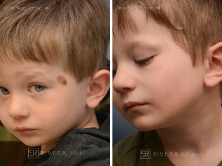 Removal (excision) of temple congenital nevus - Boy - Case 8602 - Before and after - Oblique view