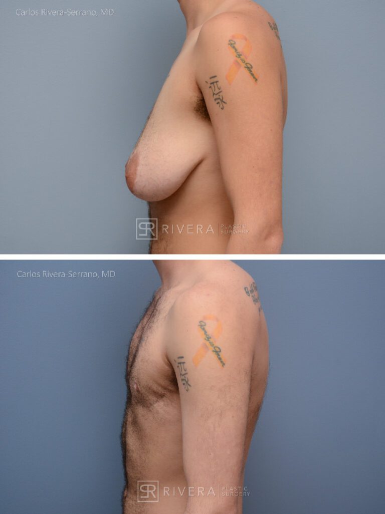 Top Surgery: Double incision mastectomy with free nipple grafting - Female to male - FTM - Masculinizing surgery - Case 21011 - Before and after - Lateral view