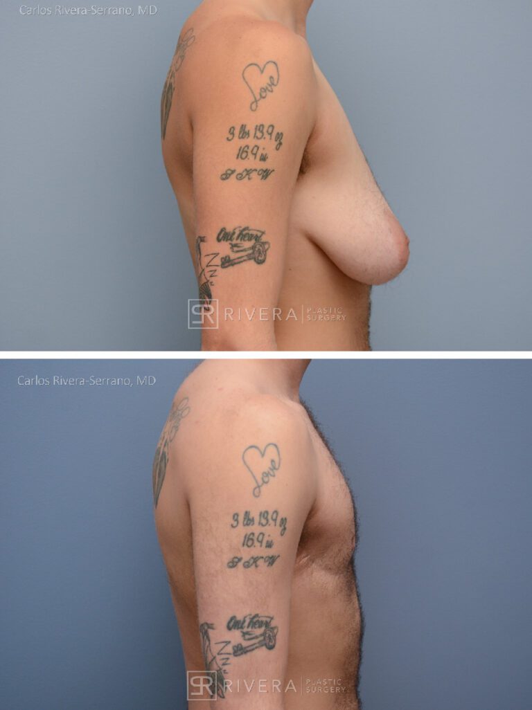 Gender affirmation top surgery from female to male - Subcutaneous Mastectomy - before and after case 1 - right lateral view