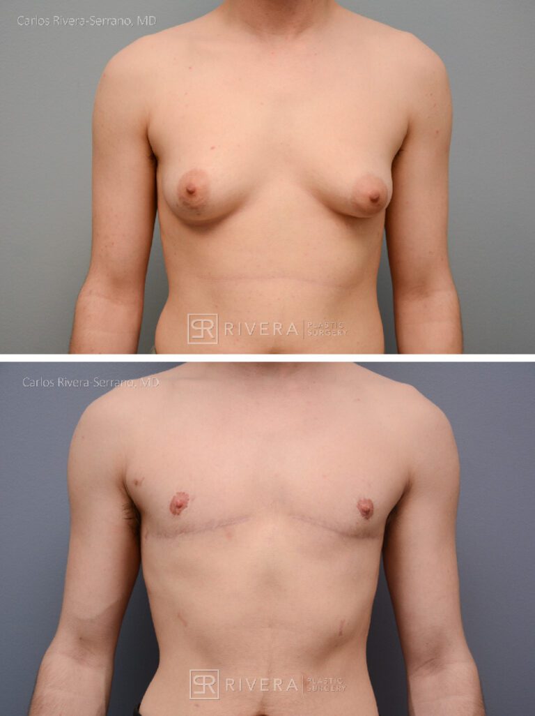 Top Surgery: Double incision mastectomy with free nipple grafting - Female to male -FTM - Masculinizing surgery - Case 21012 - Before and after - Frontal view