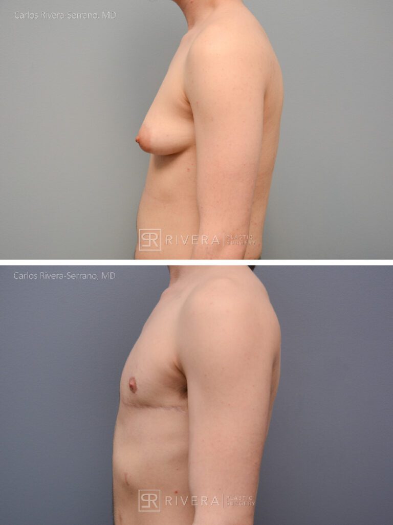 Top Surgery: Double incision mastectomy with free nipple grafting - Female to male -FTM - Masculinizing surgery - Case 21012 - Before and after - Lateral view