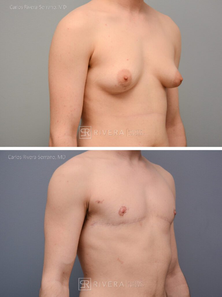Top Surgery: Double incision mastectomy with free nipple grafting - Female to male -FTM - Masculinizing surgery - Case 21012 - Before and after - Oblique view