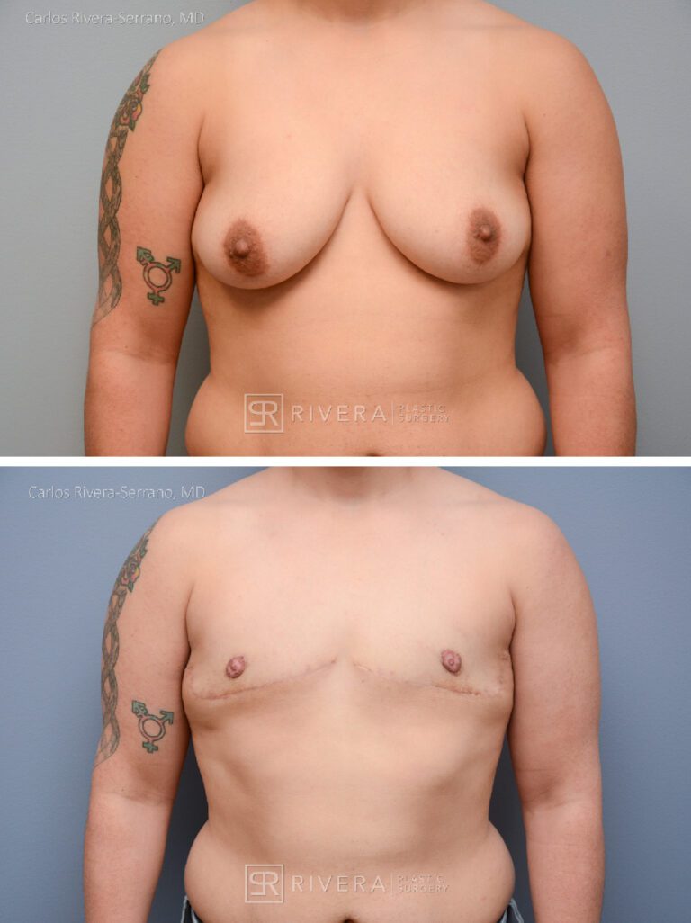 Top Surgery: Double incision mastectomy with free nipple grafting - Female to male - FTM -Masculinizing surgery -Case 21013 - Before and after - Frontal view
