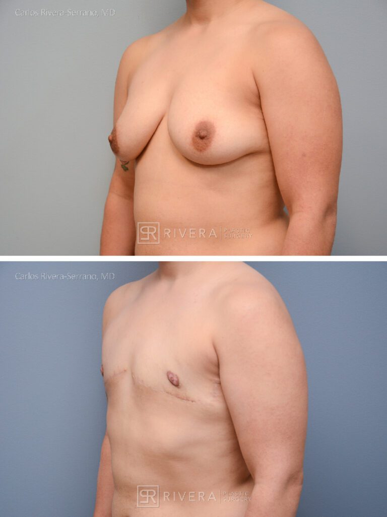 Top Surgery: Double incision mastectomy with free nipple grafting - Female to male - FTM -Masculinizing surgery -Case 21013 - Before and after - Oblique view