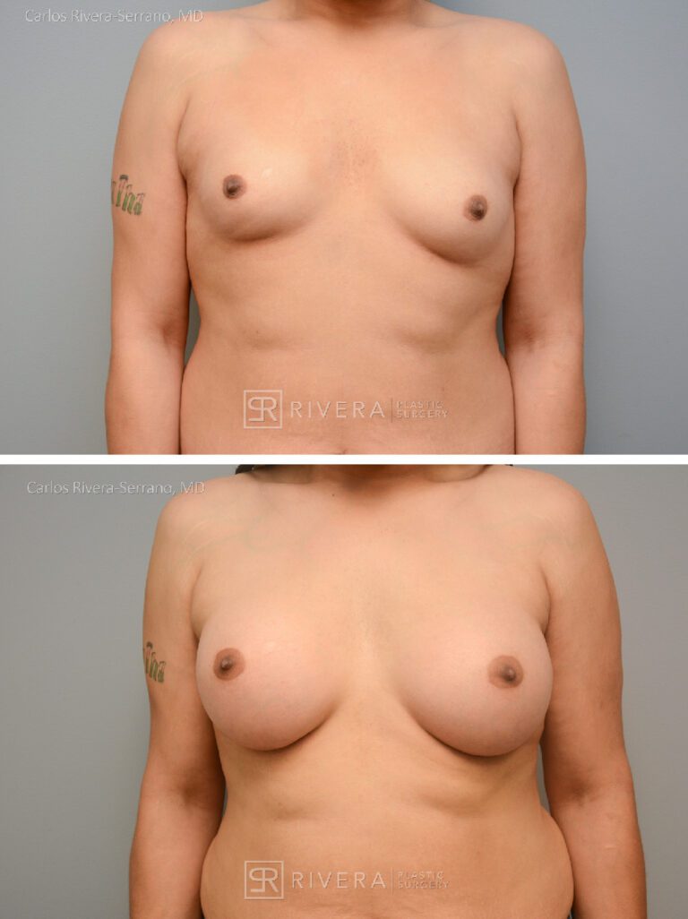 Bilateral breast augmentation MTF - Feminzing Surgery - Top Surgery - Male - Case 21021 - Before and after - Frontal view