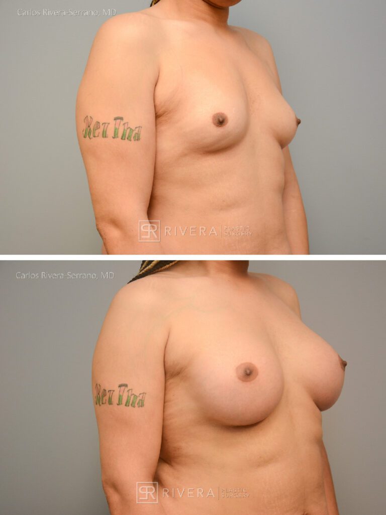 Bilateral breast augmentation MTF - Feminzing Surgery - Top Surgery - Male - Case 21021 - Before and after - Oblique view