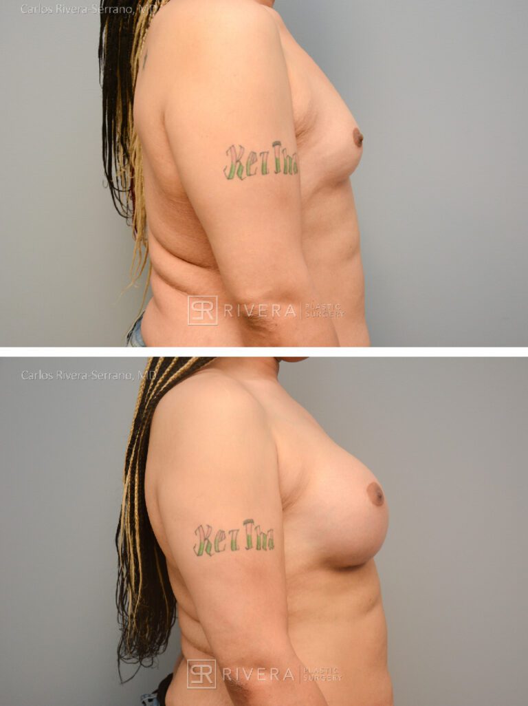 Bilateral breast augmentation MTF - Feminzing Surgery - Top Surgery - Male - Case 21021 - Before and after - Lateral view