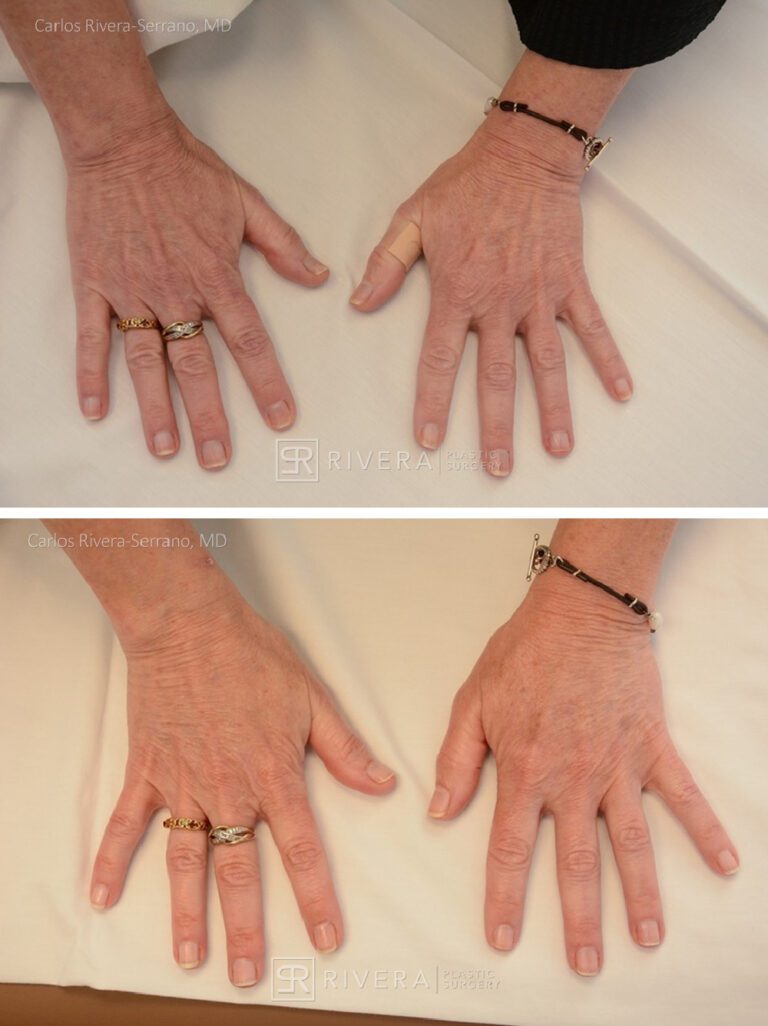Hand Rejuvenation with fat transfer - Woman - Case 31111 - Before and after - Superior view