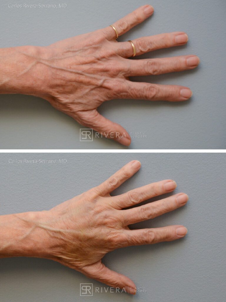 Hand Rejuvenation with fat transfer - Woman - Case 31112 - Before and after - Superior view