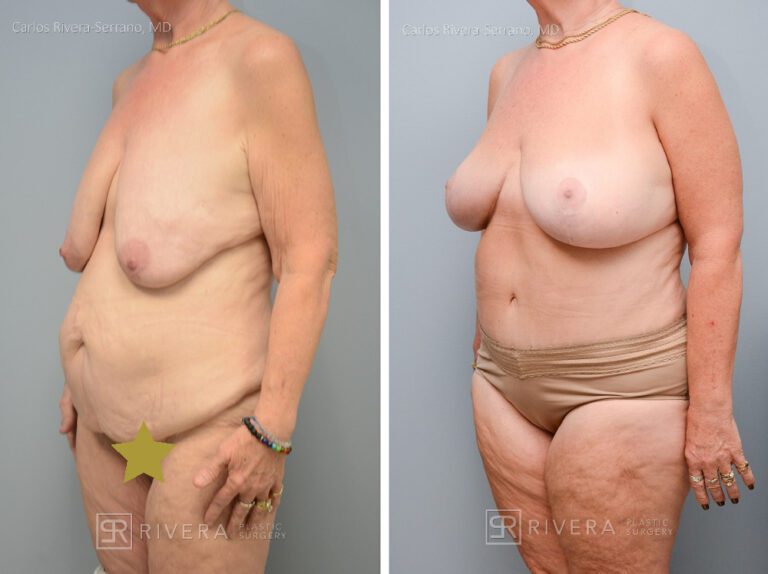 Abdominoplasty (tummy tuck) breast lift - Woman - Case 2901 - Before and after - Oblique view