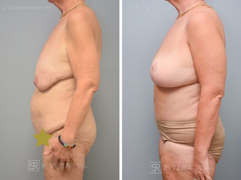 Abdominoplasty (tummy tuck) breast lift - Woman - Case 2901 - Before and after - Lateral view