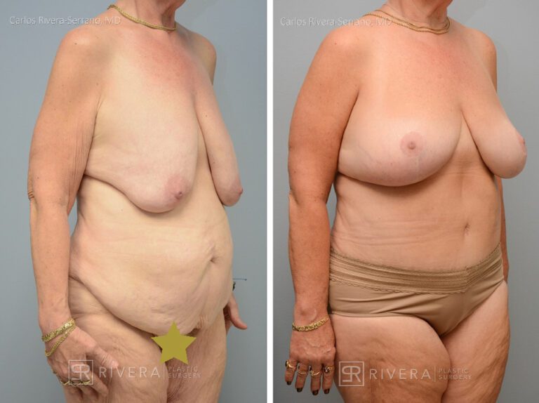 Abdominoplasty (tummy tuck) breast lift - Woman - Case 2901 - Before and after - Oblique view