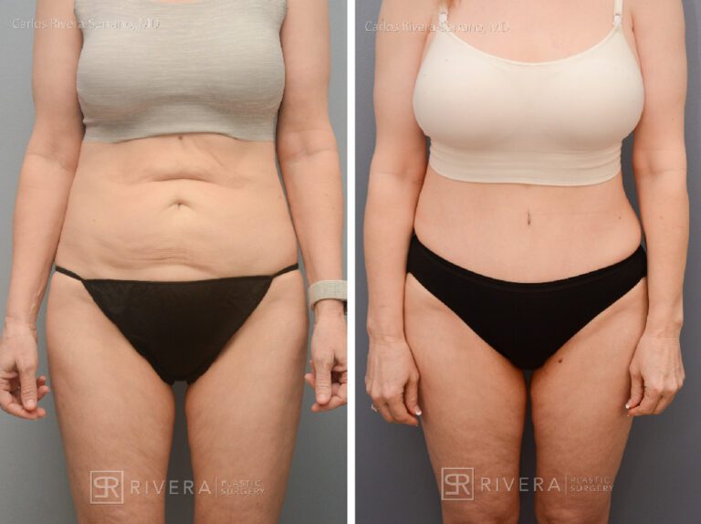 Abdominoplasty (tummy tuck) breast lift with implants - Woman - Case 2902 - Before and after - Frontal view