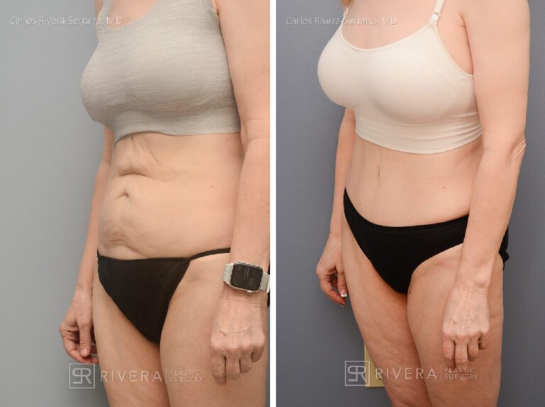 Abdominoplasty (tummy tuck) breast lift with implants - Woman - Case 2902 - Before and after - Oblique view