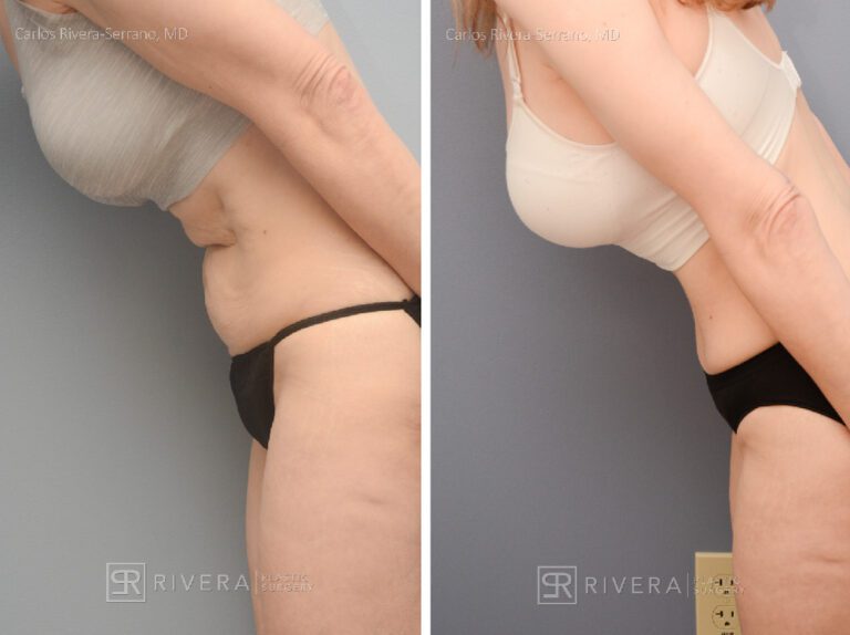 Abdominoplasty (tummy tuck) breast lift with implants - Woman - Case 2902 - Before and after - Lateral view