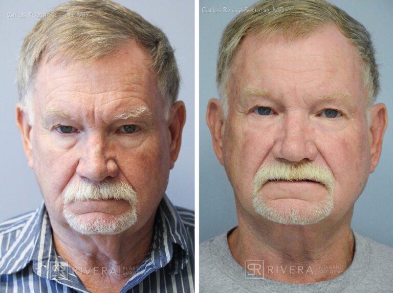 Neck lift - Man - Case 12105 - Before and after - Frontal view