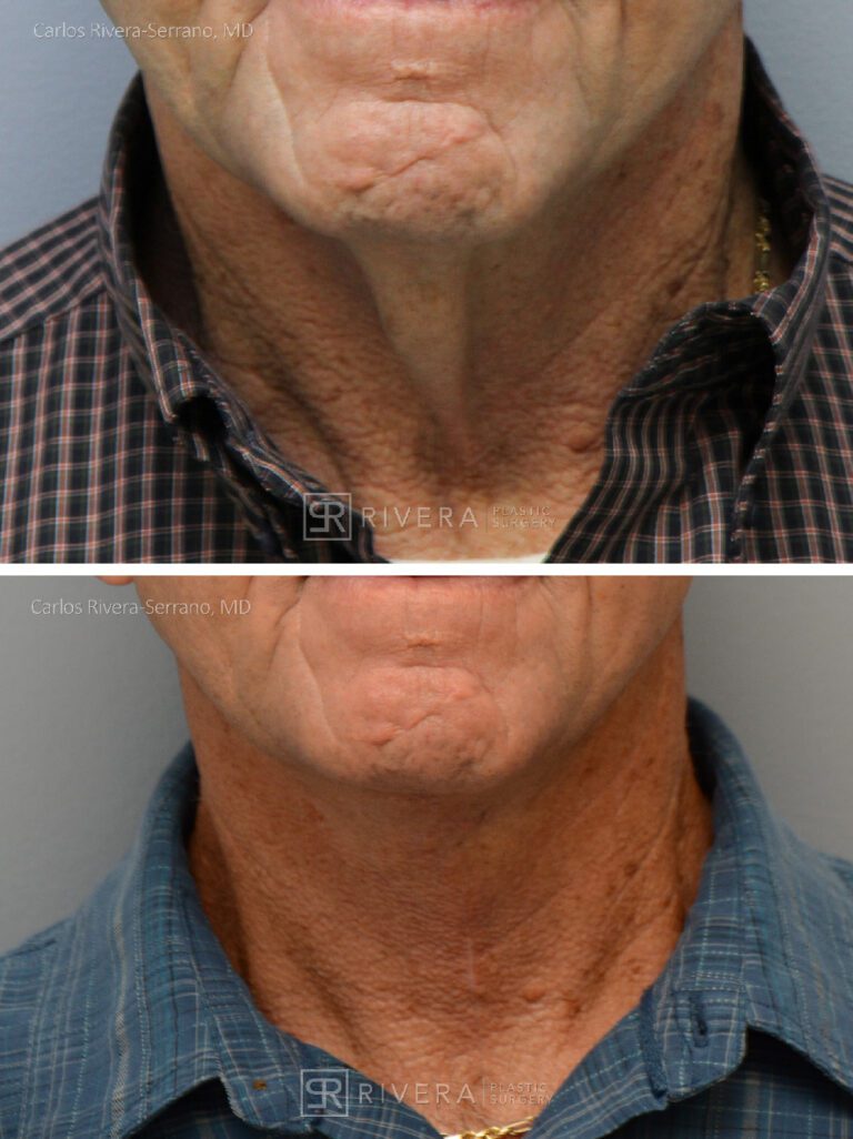 Direct Neck lift (vertical scar placed in the front of the neck) - Man - Case 12108 - Before and after - Frontal view