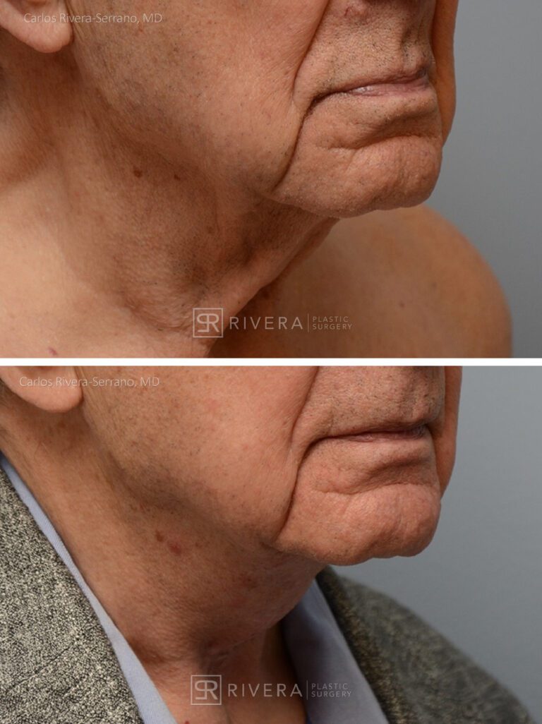 Direct Neck lift (vertical scar placed in the front of the neck) - Man - Case 12106 - Before and after - Oblique view