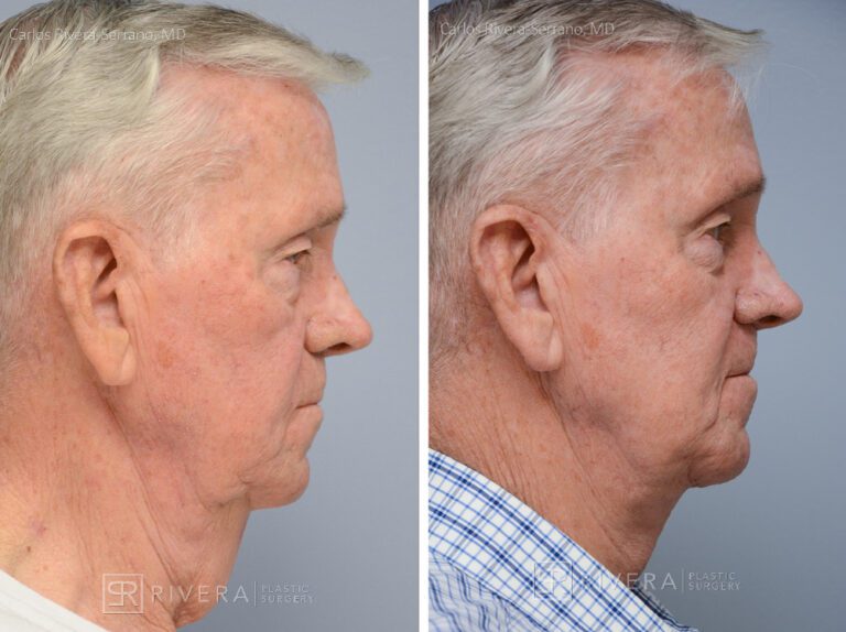 Direct Necklift (vertical scar placed in the front of the neck) - Man - Case 12104 - Before and after - Lateral view