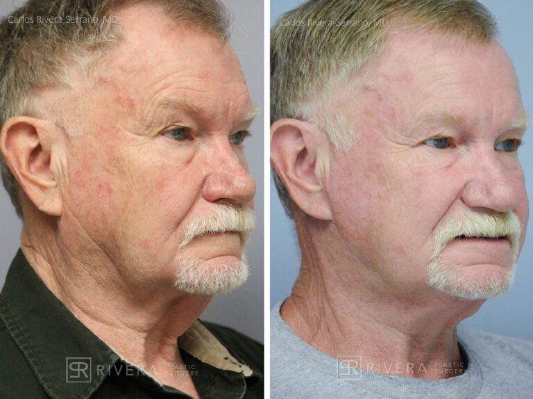 Neck lift - Man - Case 12105 - Before and after - Oblique view