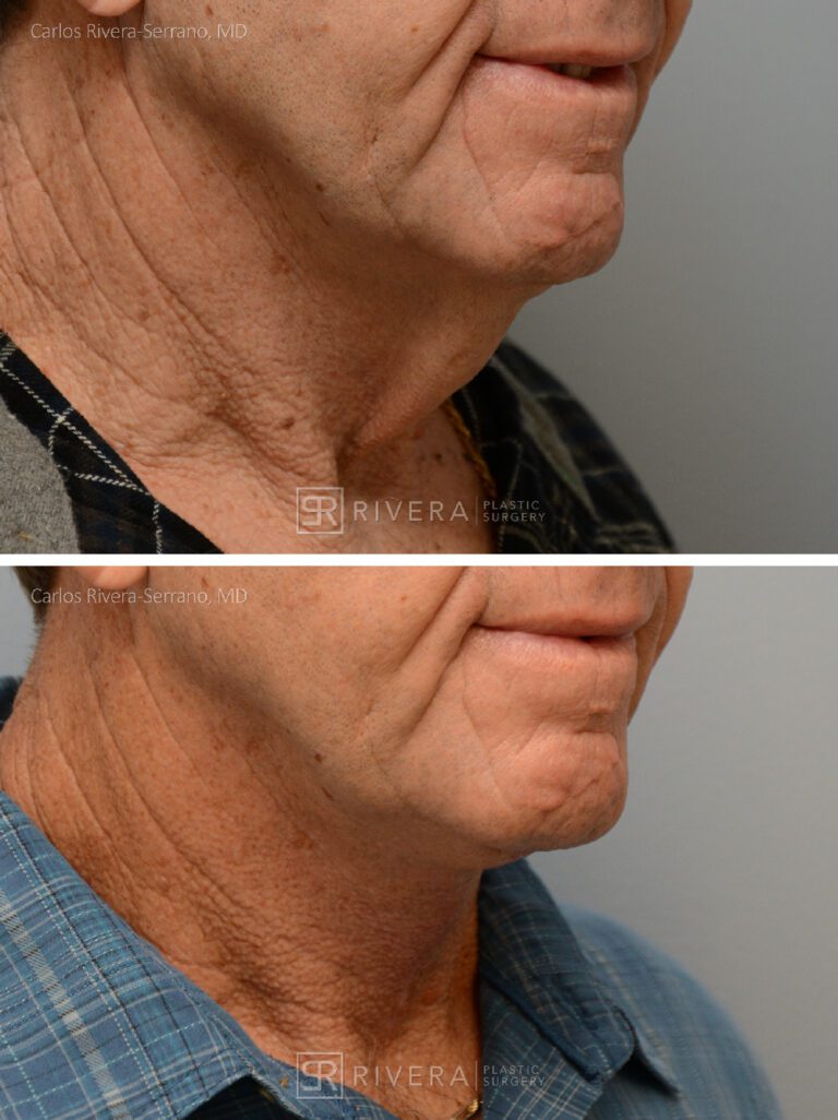 Direct Neck lift (vertical scar placed in the front of the neck) - Man - Case 12108 - Before and after - Oblique view