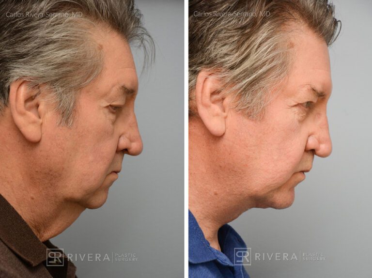 Neck lift, chin augmentation with implant - Man - Case 12102 - Before and after - Lateral view