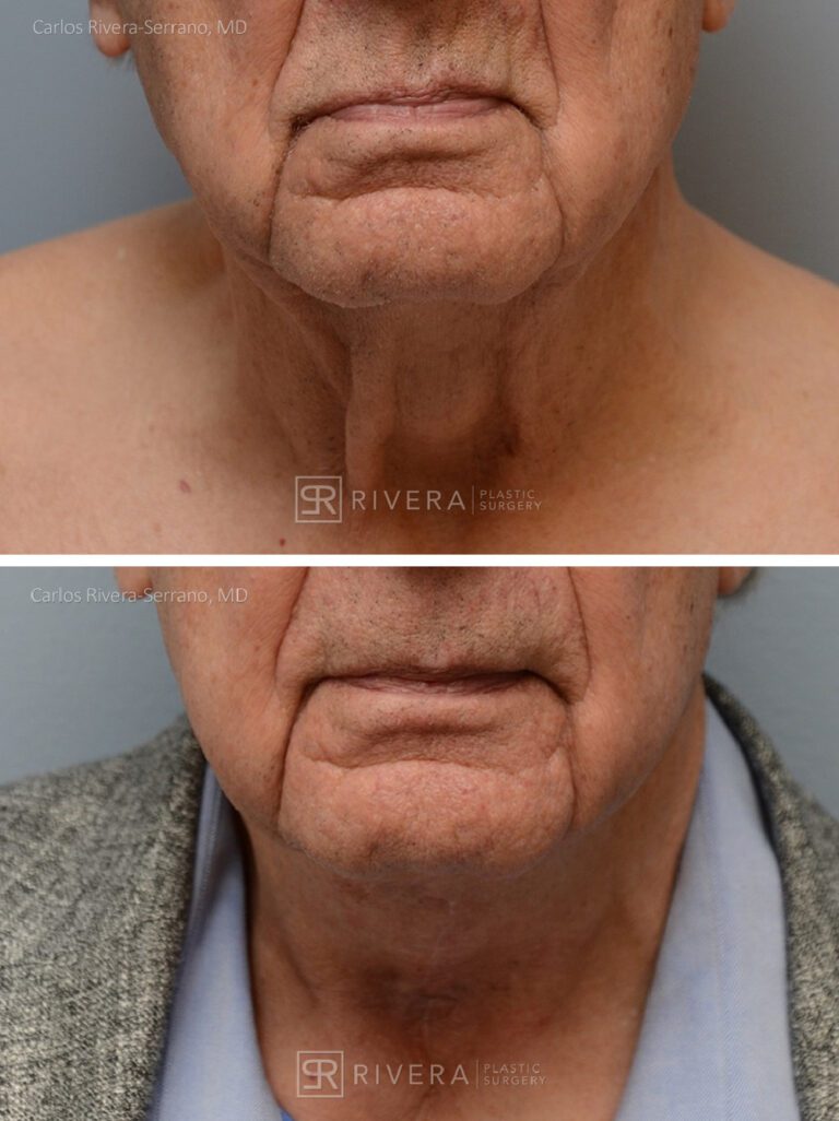 Direct Neck lift (vertical scar placed in the front of the neck) - Man - Case 12106 - Before and after - Frontal view