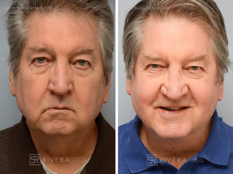 Neck lift, chin augmentation with implant - Man - Case 12102 - Before and after - Frontal view