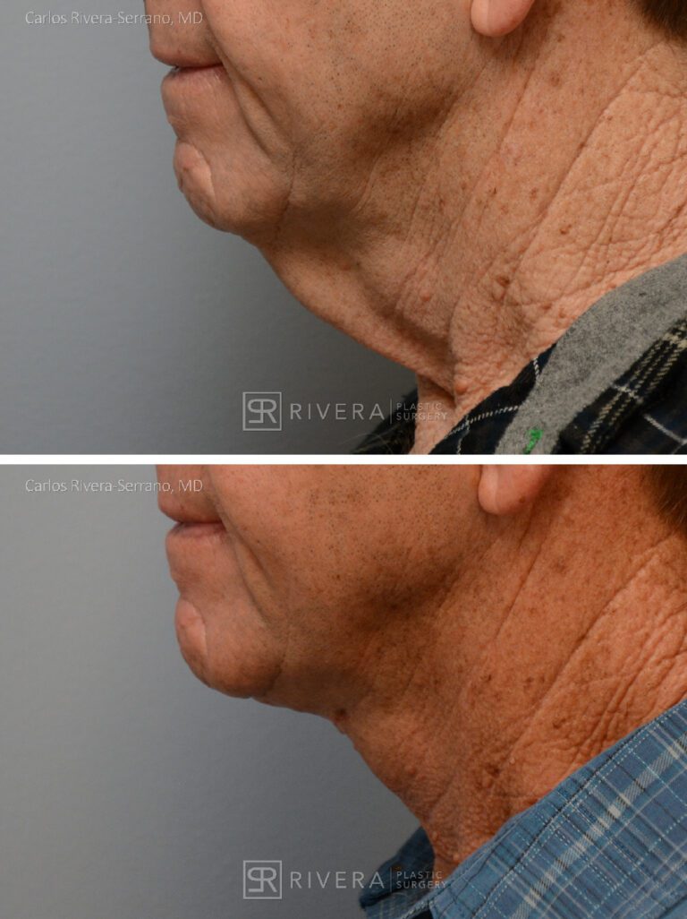 Direct Neck lift (vertical scar placed in the front of the neck) - Man - Case 12108 - Before and after - Lateral view