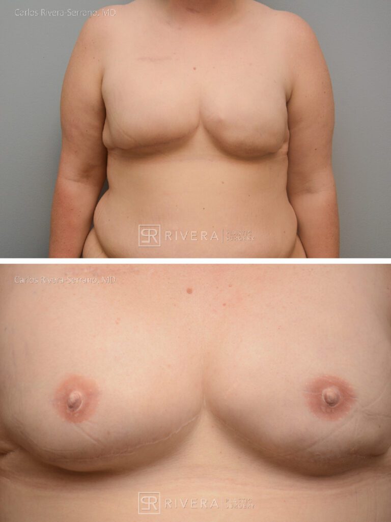 Bilateral nipple recosntruction and areaola tattoo - Woman - Case 26402 - Before and after - Frontal view