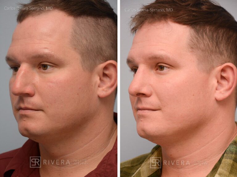 Nose surgery for man - rhinoplasty - before and after case 2 - right lateral view