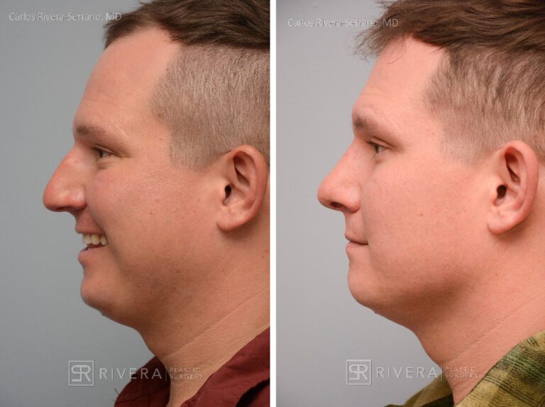 Nose surgery for man - rhinoplasty - before and after case 2 - lateral view